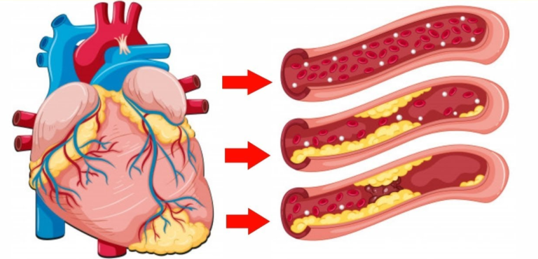 HERE ARE 12 FOODS THAT UNCLOG ARTERIES NATURALLY